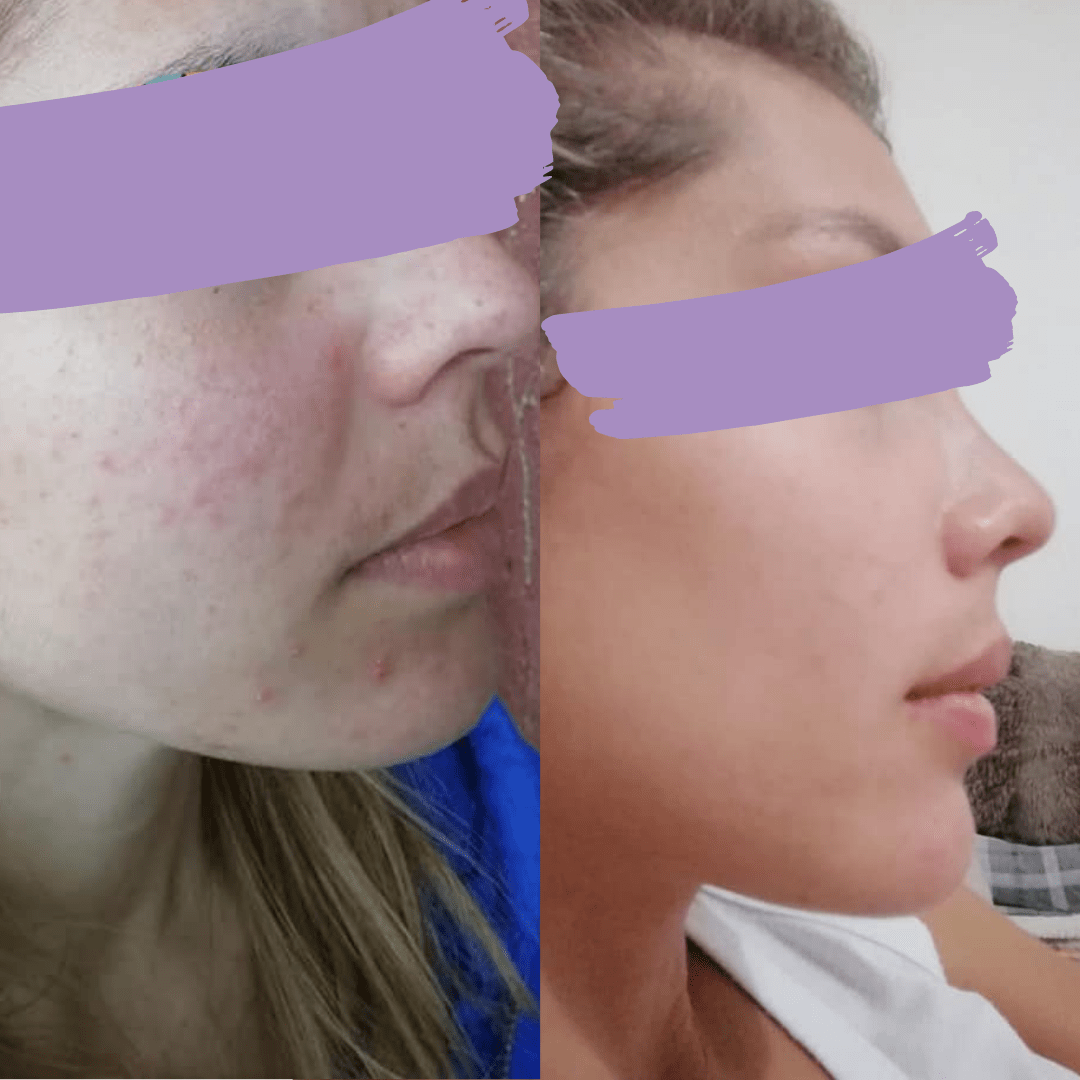 Avant après méthode Happyderme acné femme naturopathie